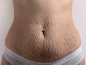 Prevén las estrías en el embarazo